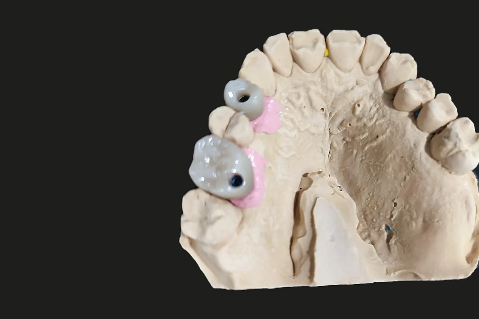 Modelo de escayola con dos coronas atornilladas sobre implantes